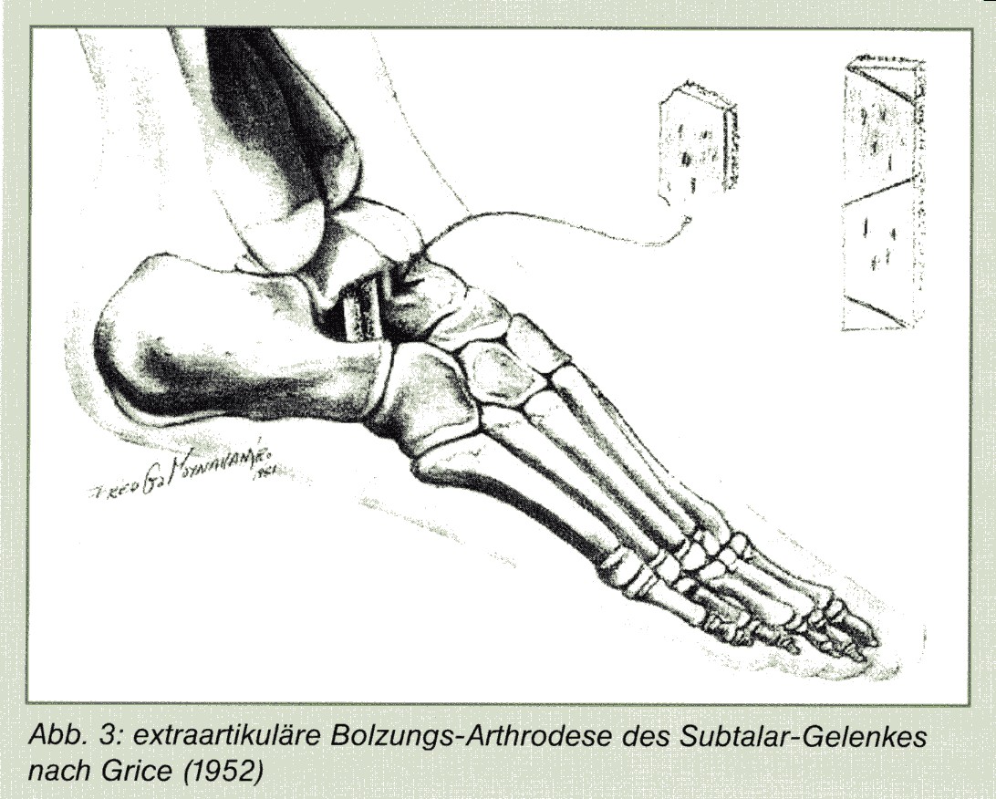 Bild 3: Bolzungs-Arthrodese